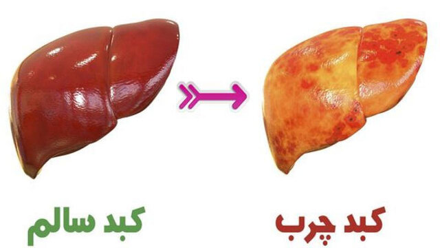 برای درمان کبد چرب چه باید کرد؟