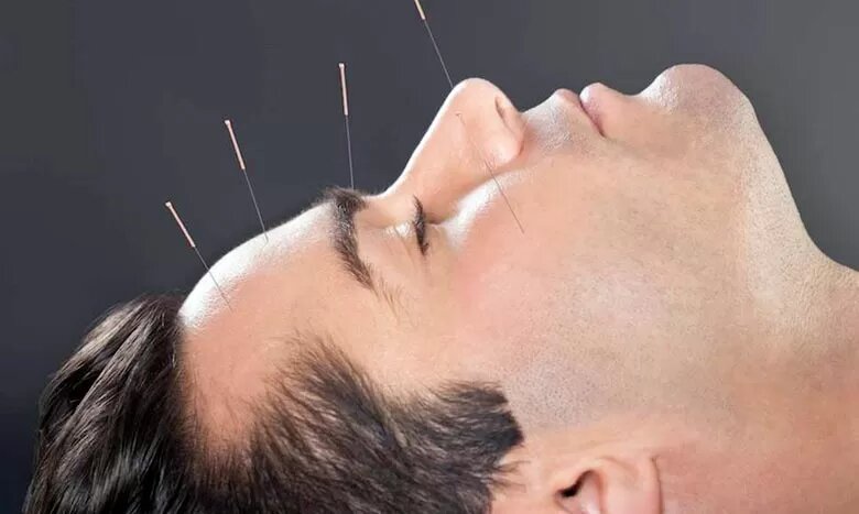 کاهش سردردهای تنشی با طب سوزنی