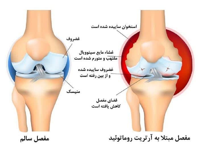 کنترل و کاهش عوارض بیماری آرتریت روماتوئید با مصرف غذا‌های ضدالتهاب