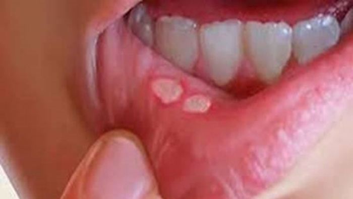 هشدار نسبت به علائم خاموش سرطانهای دهان هشدار نسبت به علائم خاموش سرطانهای دهان