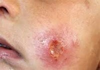 ثبت بیش از هزار و ۵۰۰ مورد ابتلا به سالک در خراسان رضوی