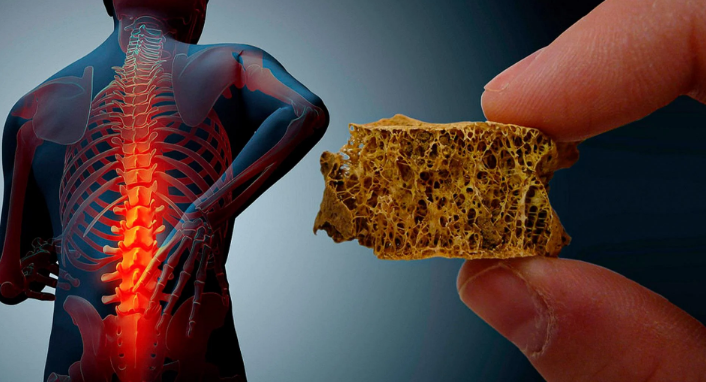چگونه از  پوکی استخوان جلوگیری کنیم؟ چگونه از  پوکی استخوان جلوگیری کنیم؟